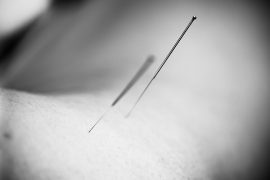 Medicinsk akupunktur.