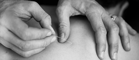 Dry needling.